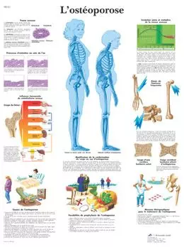 Anatomische Bord : Osteoporose VR2121UU