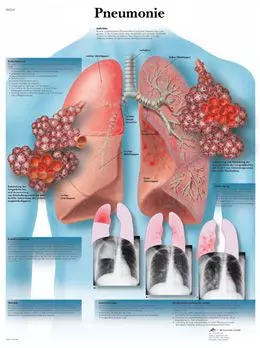 Anatomische Bord : Pneumonie VR2326UU