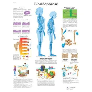 Anatomische Bord : Osteoporose VR2121UU