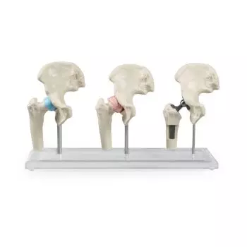 Hüft-Implantat-Modell Erler Zimmer